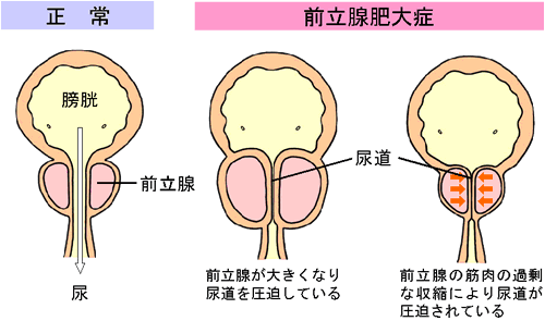 前立腺肥大の症状 原因について 公式 横幕鍼灸院